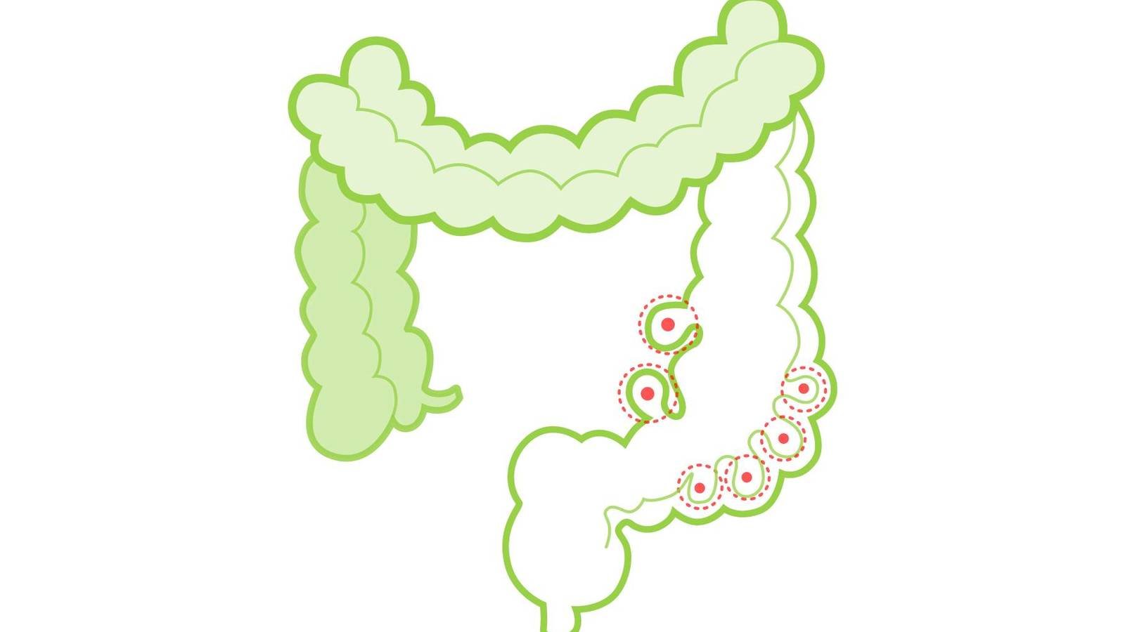 Enfermedad Diverticular